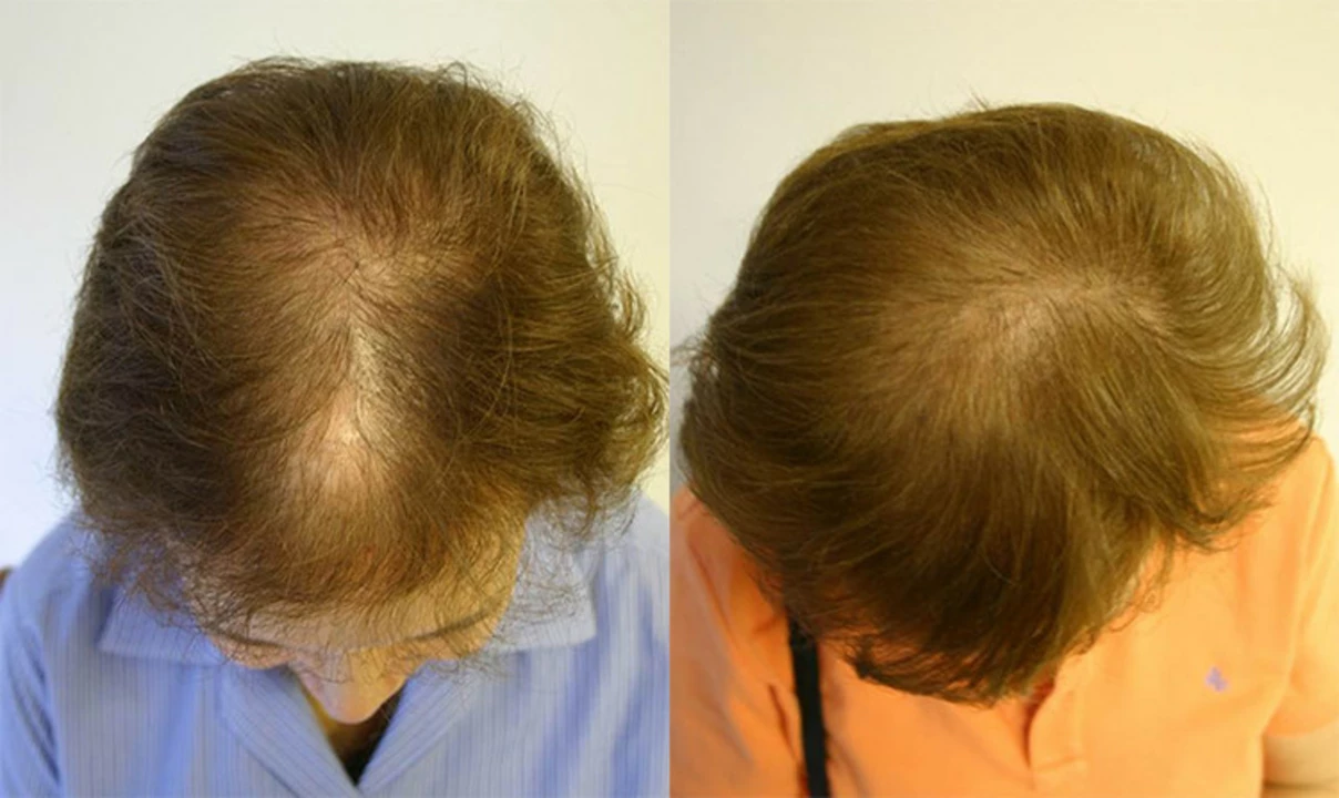 Atenolol and hair loss: Is there a connection?