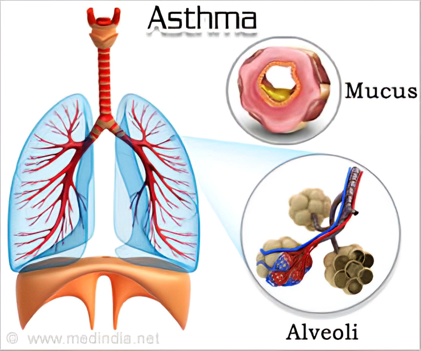 Meloxicam and Asthma: A Potential Risk to Consider