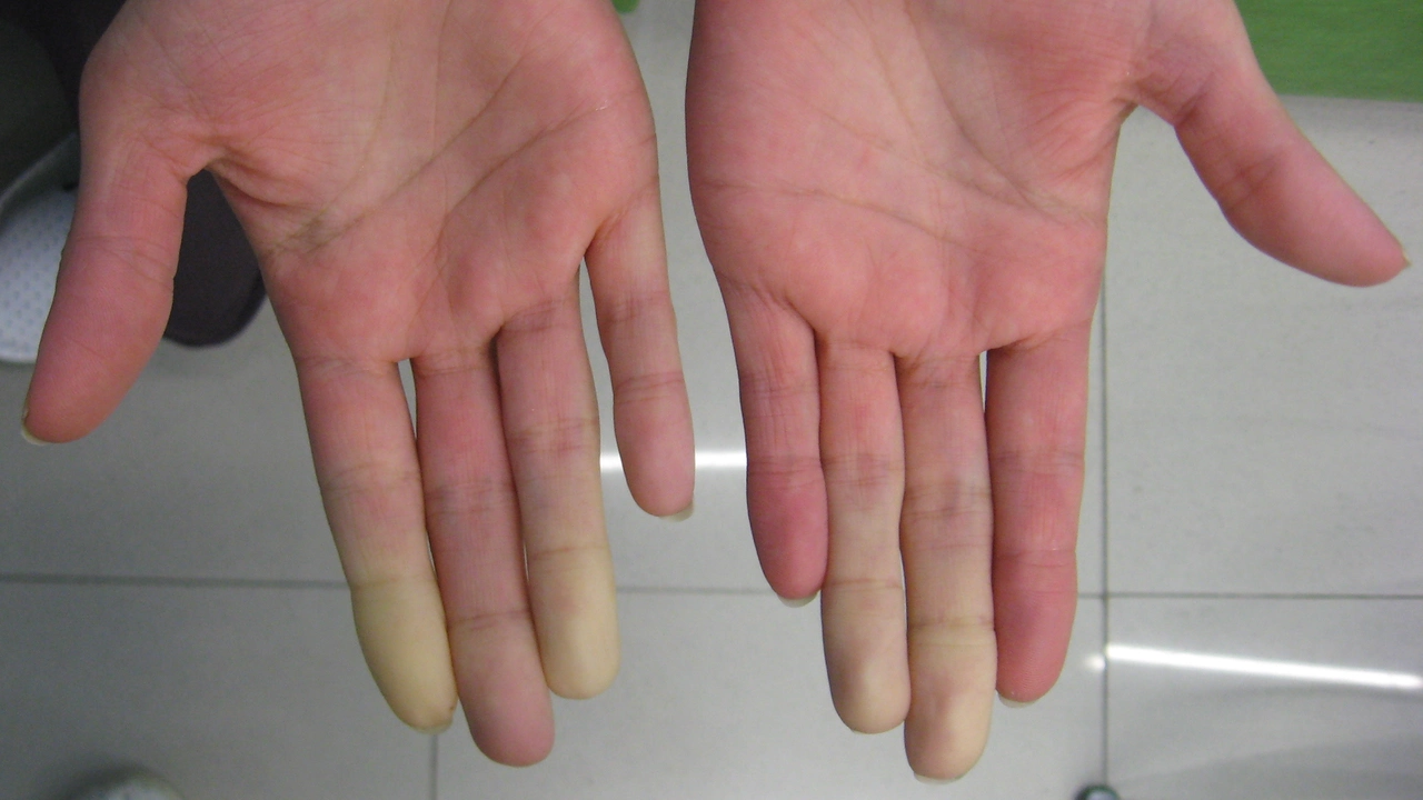 The Connection Between Lupus and Raynaud's Phenomenon